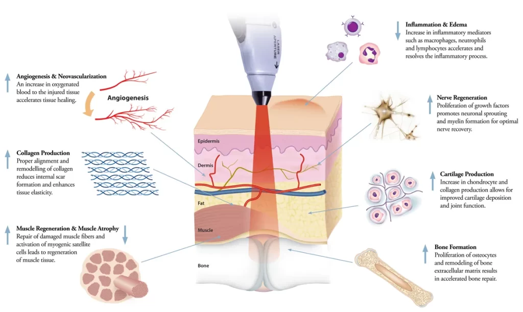 mechanism of laser therapy